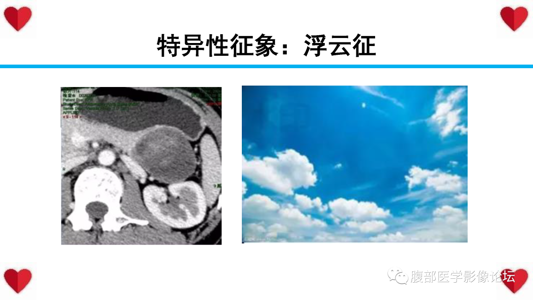 影像PPT - 【PPT】胰腺实性假乳头状瘤（SPN）影像诊断-44
