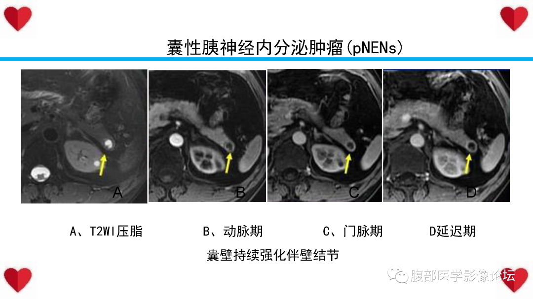 影像PPT - 【PPT】胰腺实性假乳头状瘤（SPN）影像诊断-48