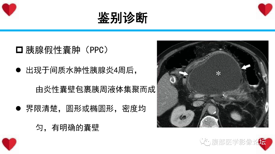 影像PPT - 【PPT】胰腺实性假乳头状瘤（SPN）影像诊断-51