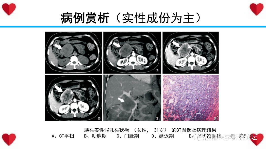 影像PPT - 【PPT】胰腺实性假乳头状瘤（SPN）影像诊断-41
