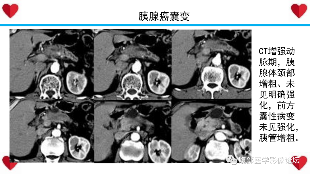 影像PPT - 【PPT】胰腺实性假乳头状瘤（SPN）影像诊断-53