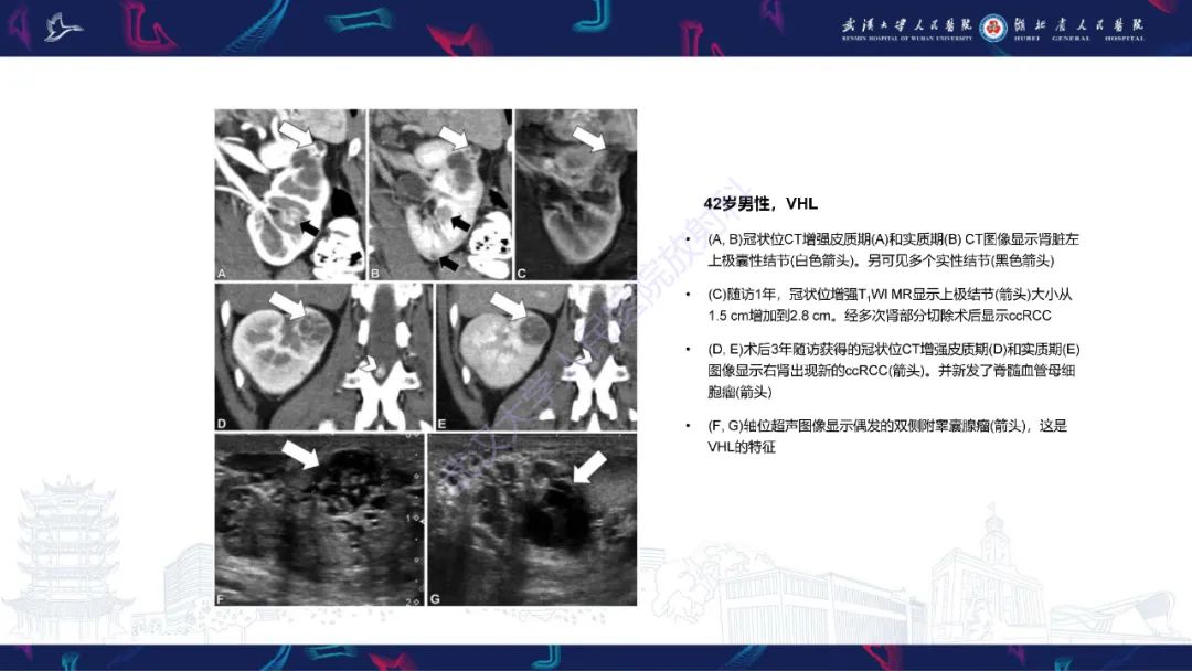 影像PPT - 【PPT】青年人肾脏肿瘤影像诊断-5