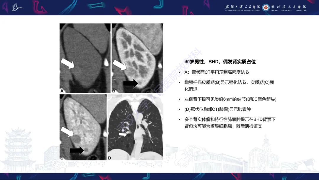 影像PPT - 【PPT】青年人肾脏肿瘤影像诊断-9