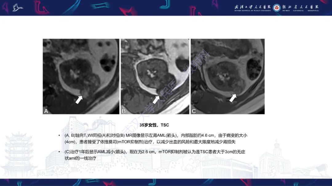 影像PPT - 【PPT】青年人肾脏肿瘤影像诊断-12
