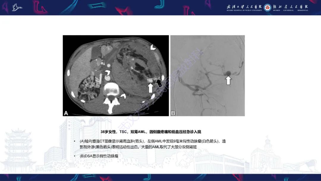 影像PPT - 【PPT】青年人肾脏肿瘤影像诊断-13