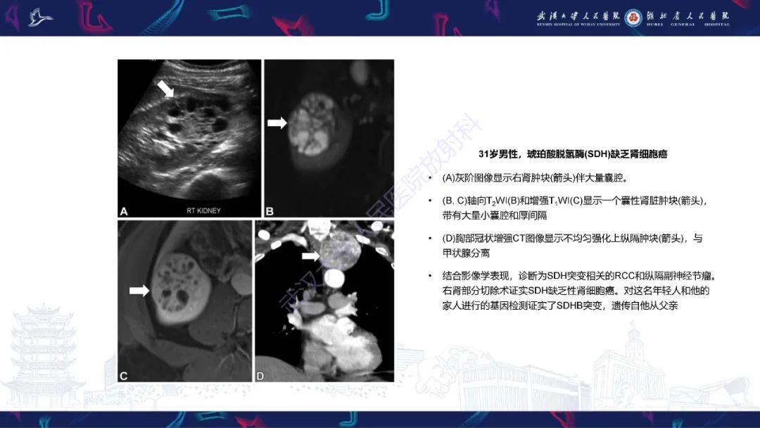 影像PPT - 【PPT】青年人肾脏肿瘤影像诊断-15
