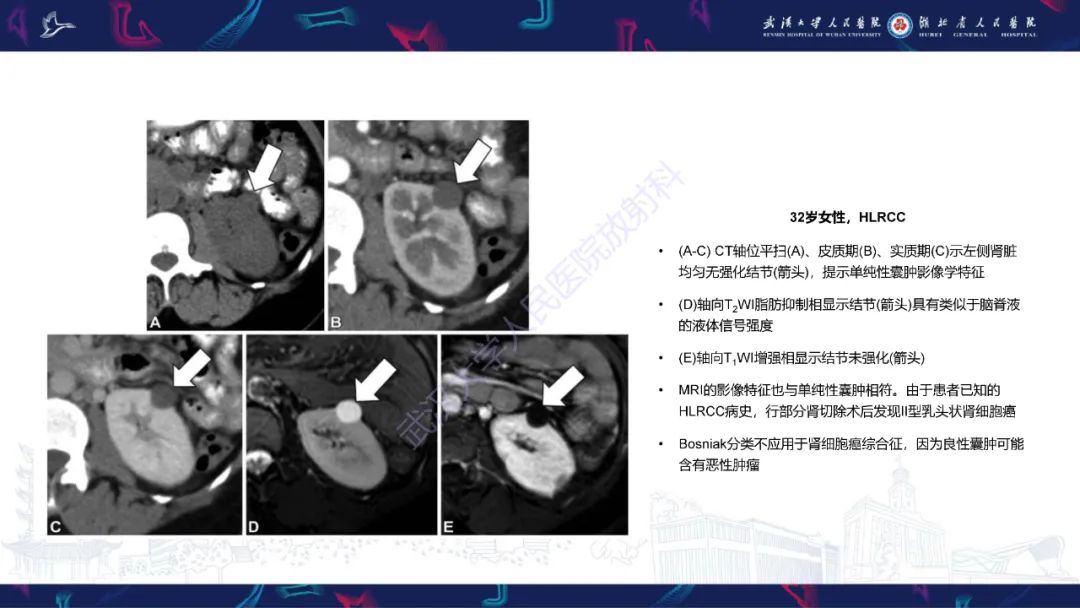 影像PPT - 【PPT】青年人肾脏肿瘤影像诊断-17