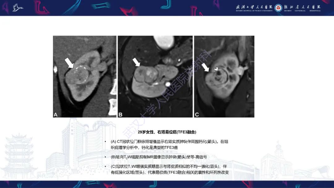 影像PPT - 【PPT】青年人肾脏肿瘤影像诊断-20