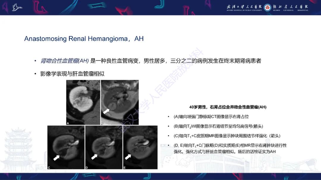 影像PPT - 【PPT】青年人肾脏肿瘤影像诊断-23