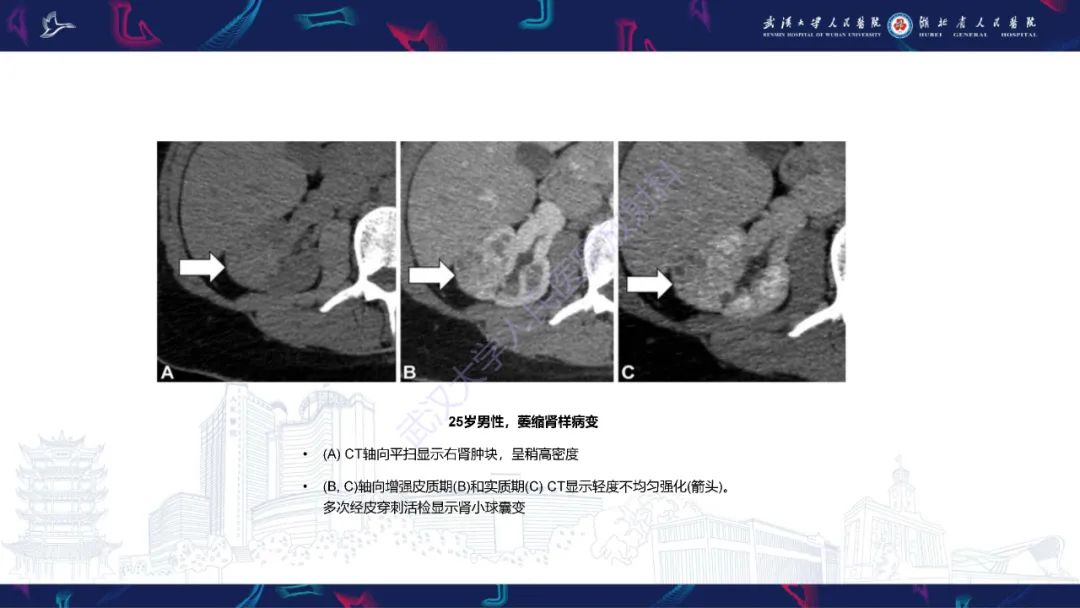 影像PPT - 【PPT】青年人肾脏肿瘤影像诊断-22