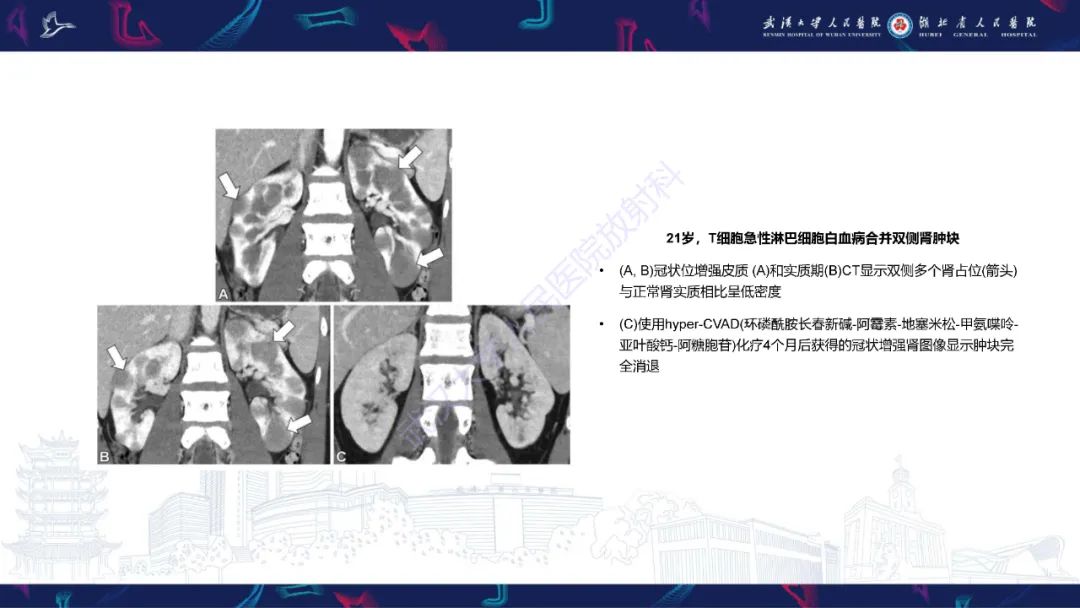 影像PPT - 【PPT】青年人肾脏肿瘤影像诊断-25