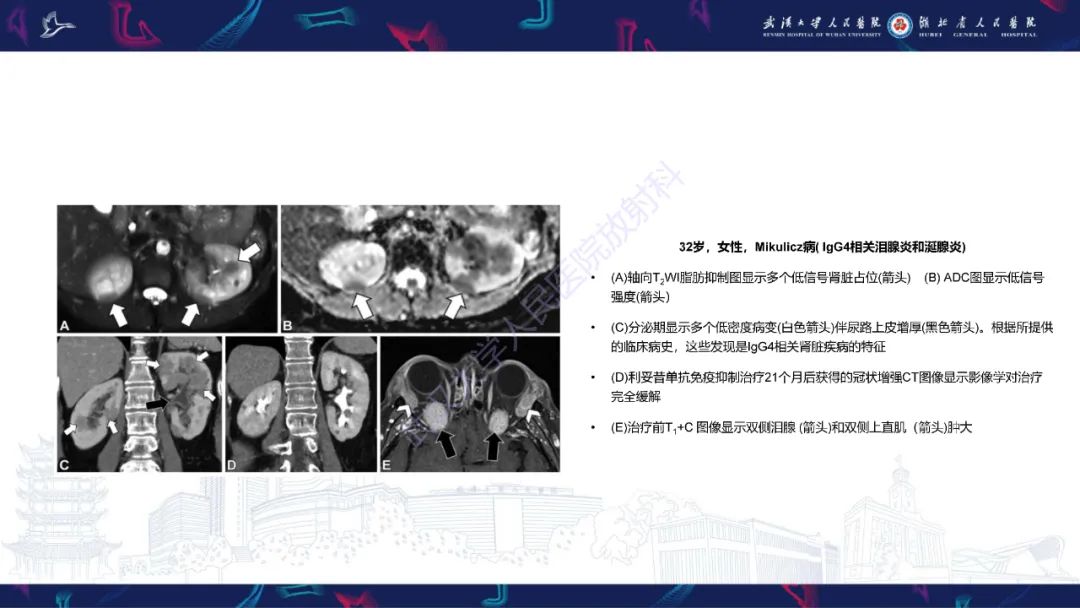 影像PPT - 【PPT】青年人肾脏肿瘤影像诊断-27