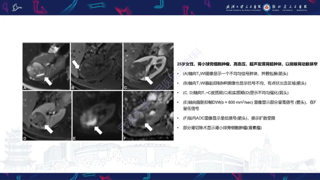 影像PPT - 【PPT】青年人肾脏肿瘤影像诊断-29