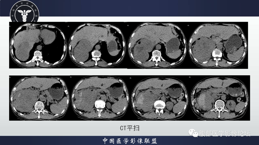 影像PPT - 【病例】恶性外周神经鞘瘤1例CT及MR影像诊断-5