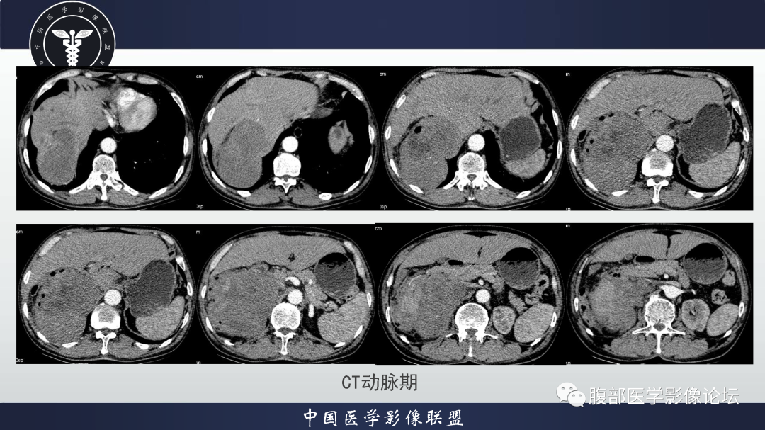 影像PPT - 【病例】恶性外周神经鞘瘤1例CT及MR影像诊断-6