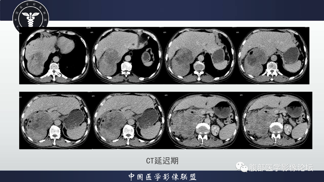 影像PPT - 【病例】恶性外周神经鞘瘤1例CT及MR影像诊断-7