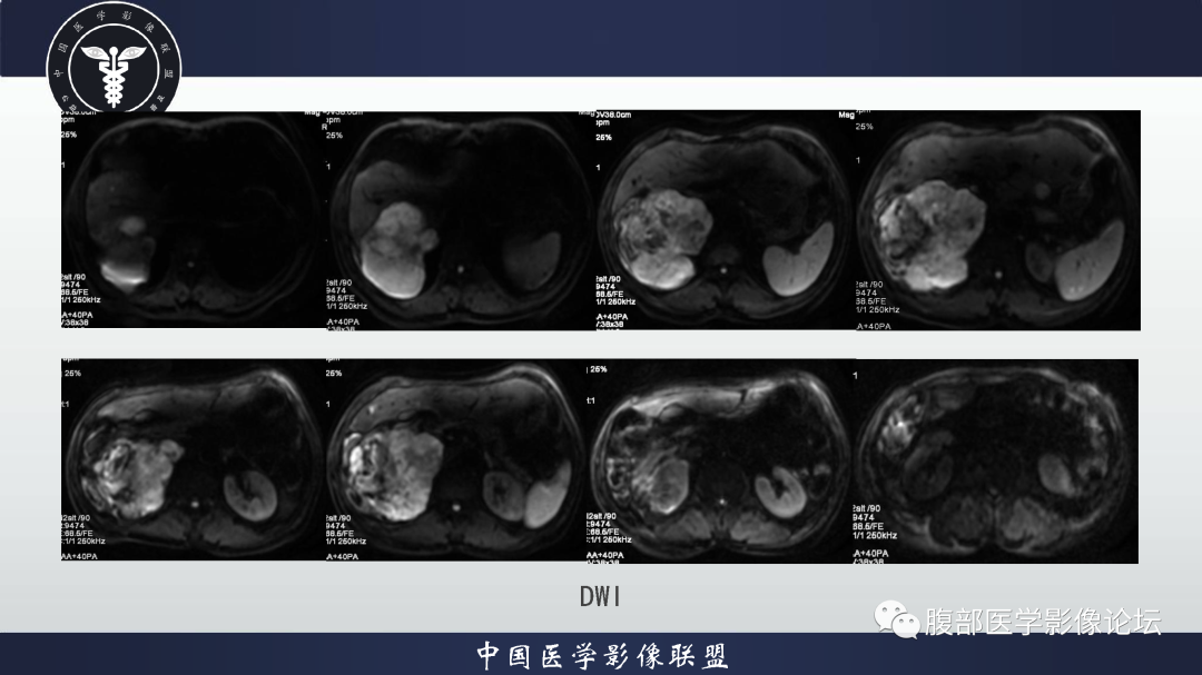 影像PPT - 【病例】恶性外周神经鞘瘤1例CT及MR影像诊断-10