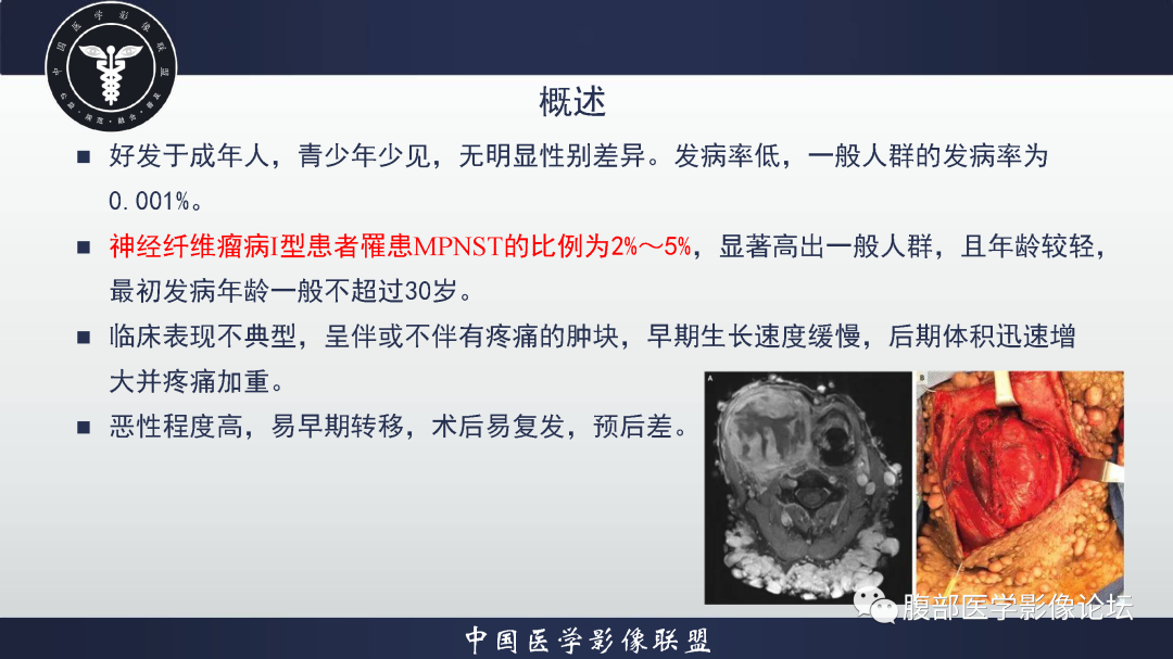 影像PPT - 【病例】恶性外周神经鞘瘤1例CT及MR影像诊断-16