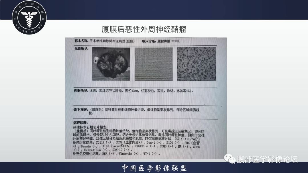 影像PPT - 【病例】恶性外周神经鞘瘤1例CT及MR影像诊断-14