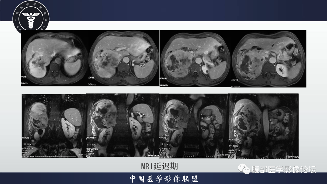 影像PPT - 【病例】恶性外周神经鞘瘤1例CT及MR影像诊断-12