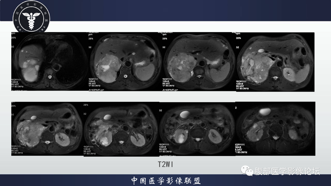 影像PPT - 【病例】恶性外周神经鞘瘤1例CT及MR影像诊断-8