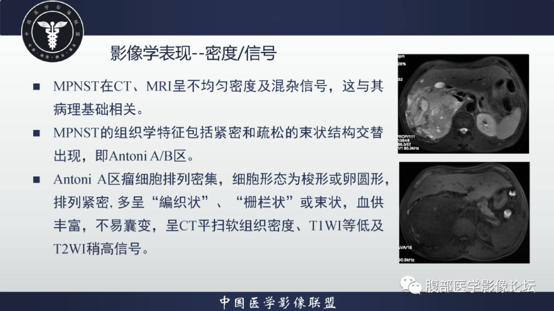 影像PPT - 【病例】恶性外周神经鞘瘤1例CT及MR影像诊断-20