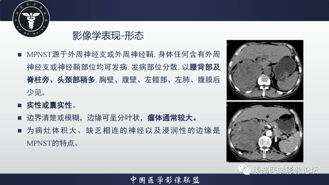 影像PPT - 【病例】恶性外周神经鞘瘤1例CT及MR影像诊断-19