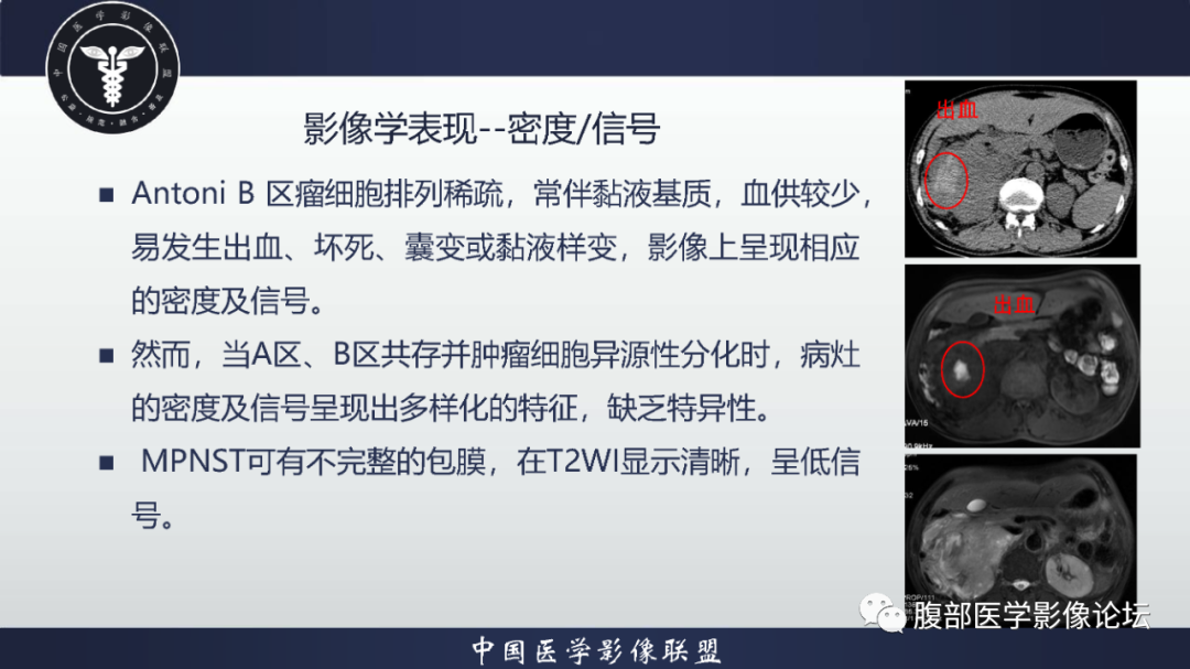 影像PPT - 【病例】恶性外周神经鞘瘤1例CT及MR影像诊断-21