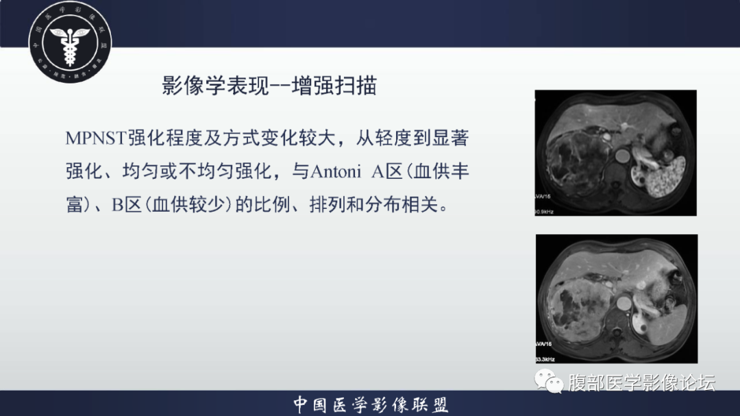 影像PPT - 【病例】恶性外周神经鞘瘤1例CT及MR影像诊断-22