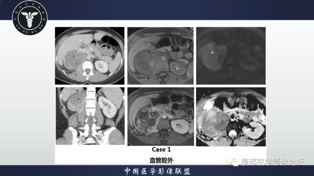 影像PPT - 【病例】恶性外周神经鞘瘤1例CT及MR影像诊断-27