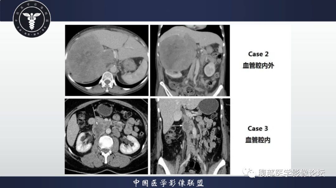 影像PPT - 【病例】恶性外周神经鞘瘤1例CT及MR影像诊断-28