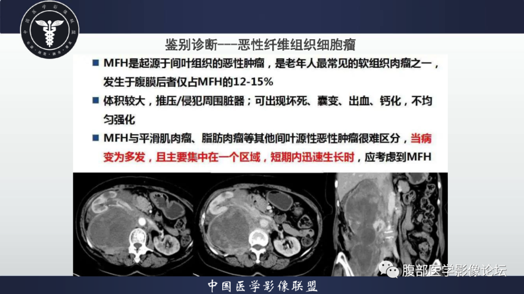 影像PPT - 【病例】恶性外周神经鞘瘤1例CT及MR影像诊断-30
