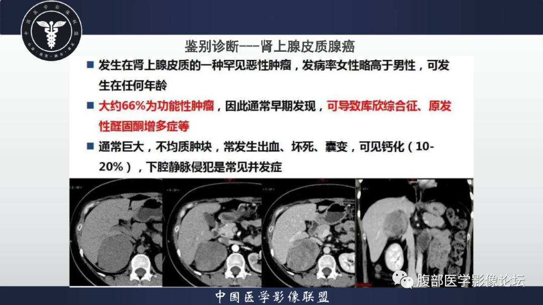 影像PPT - 【病例】恶性外周神经鞘瘤1例CT及MR影像诊断-31