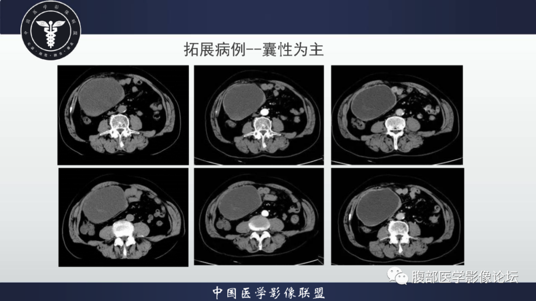 影像PPT - 【病例】恶性外周神经鞘瘤1例CT及MR影像诊断-25