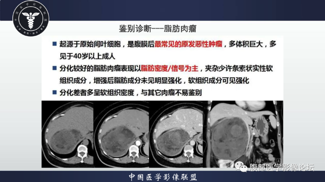 影像PPT - 【病例】恶性外周神经鞘瘤1例CT及MR影像诊断-29