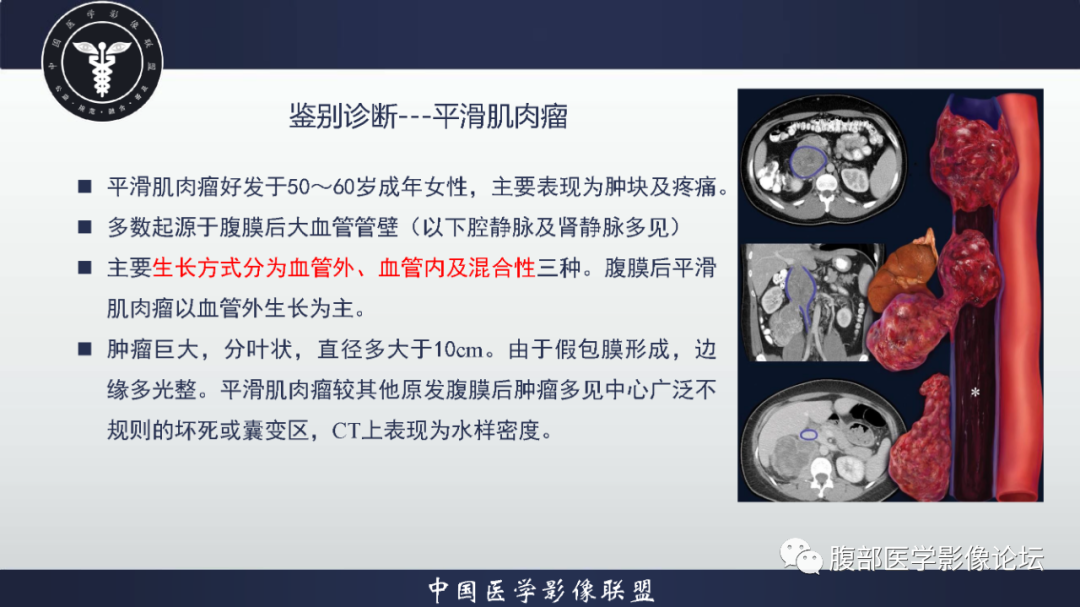 影像PPT - 【病例】恶性外周神经鞘瘤1例CT及MR影像诊断-26