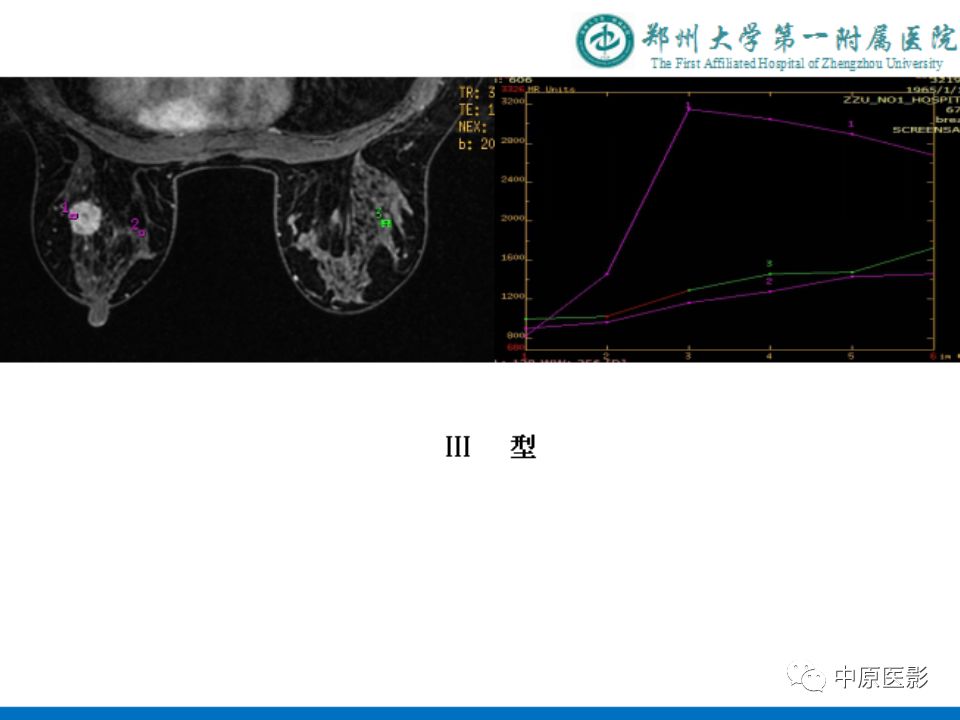 影像PPT - 【PPT】MRI对乳腺癌的诊断价值-17