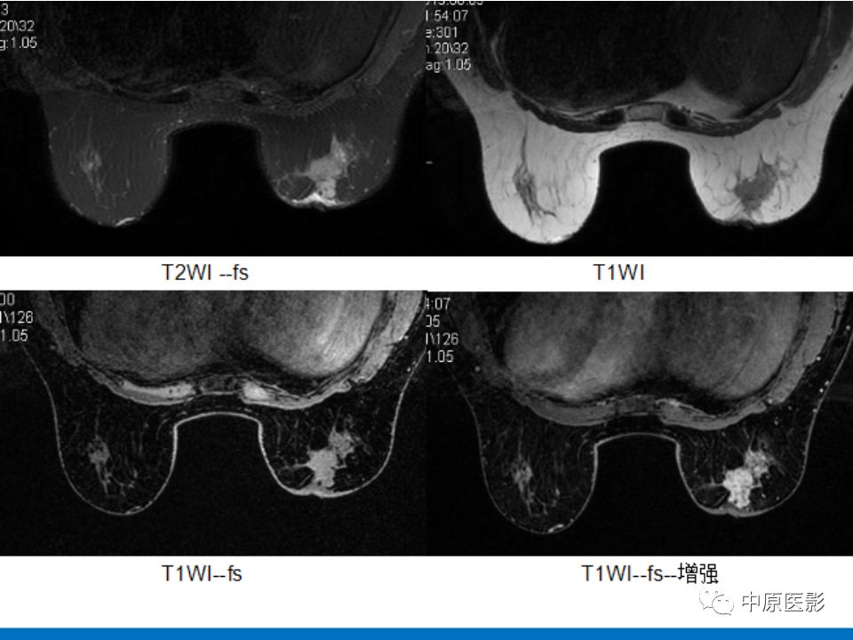 影像PPT - 【PPT】MRI对乳腺癌的诊断价值-19