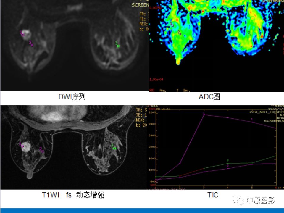 影像PPT - 【PPT】MRI对乳腺癌的诊断价值-24