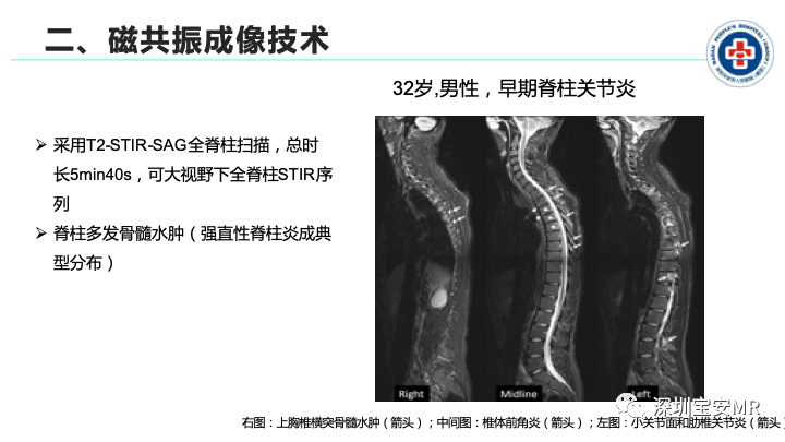 影像PPT - 【PPT】磁共振成像在风湿性疾病中的应用-6