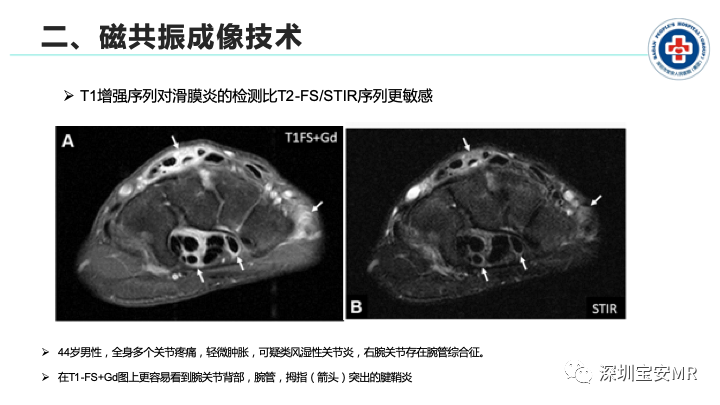 影像PPT - 【PPT】磁共振成像在风湿性疾病中的应用-7