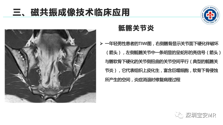 影像PPT - 【PPT】磁共振成像在风湿性疾病中的应用-15
