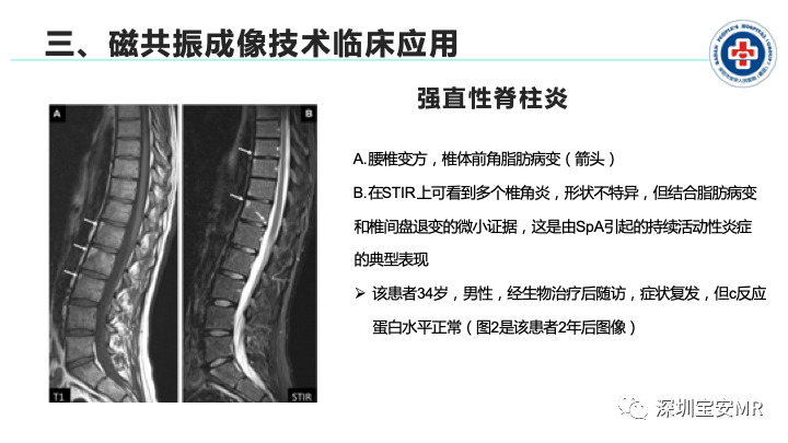 影像PPT - 【PPT】磁共振成像在风湿性疾病中的应用-16