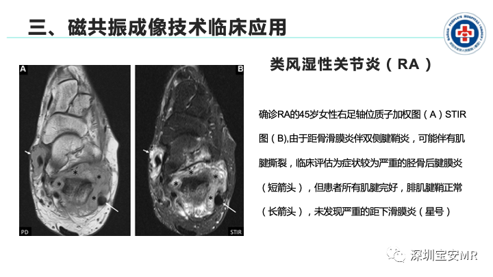 影像PPT - 【PPT】磁共振成像在风湿性疾病中的应用-18