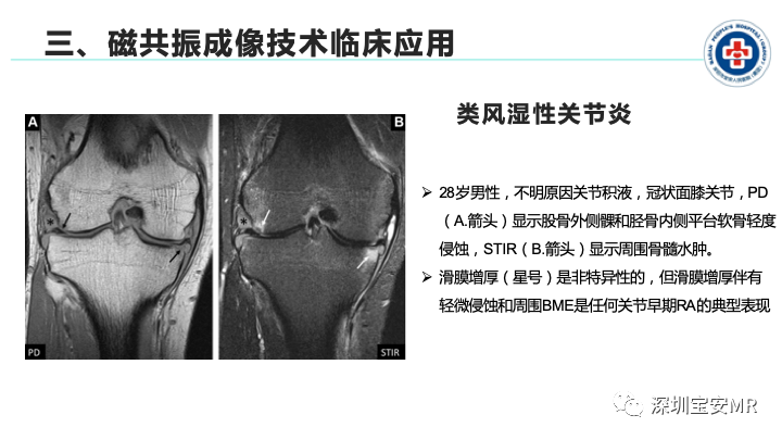 影像PPT - 【PPT】磁共振成像在风湿性疾病中的应用-19