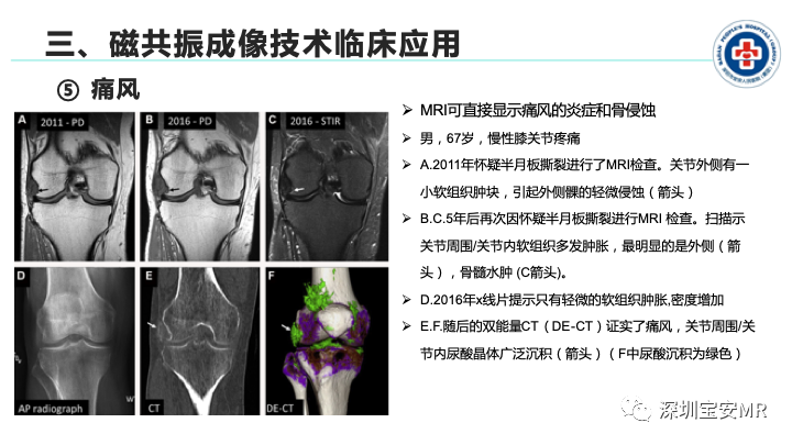 影像PPT - 【PPT】磁共振成像在风湿性疾病中的应用-24