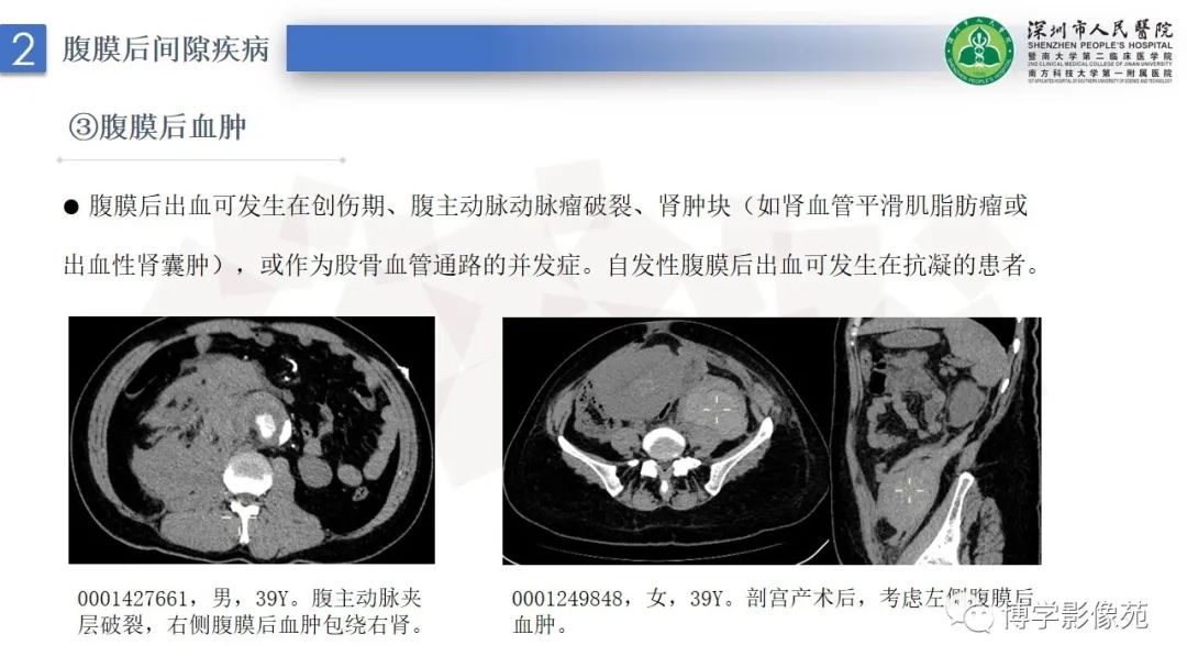 影像PPT - 【PPT】腹膜后间隙及肾上腺常见疾病影像表现-11