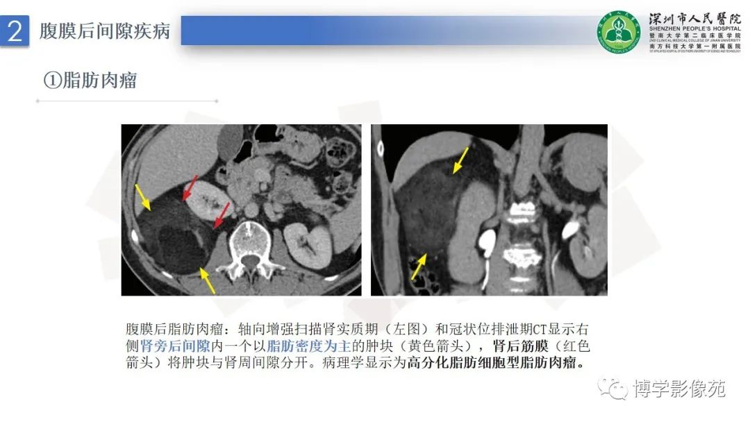 影像PPT - 【PPT】腹膜后间隙及肾上腺常见疾病影像表现-8