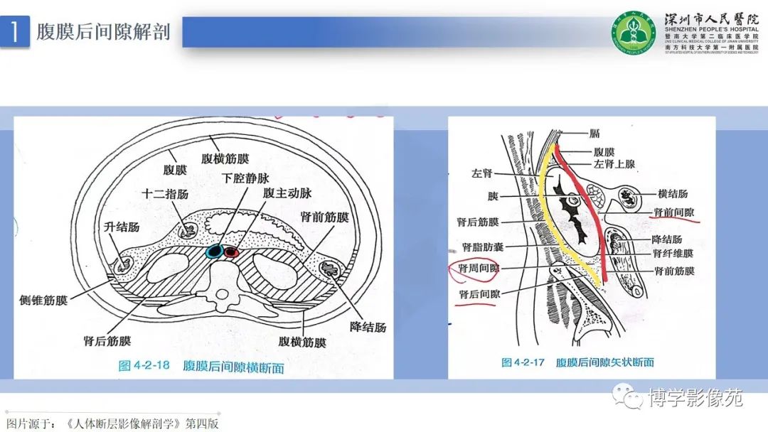 影像PPT - 【PPT】腹膜后间隙及肾上腺常见疾病影像表现-5