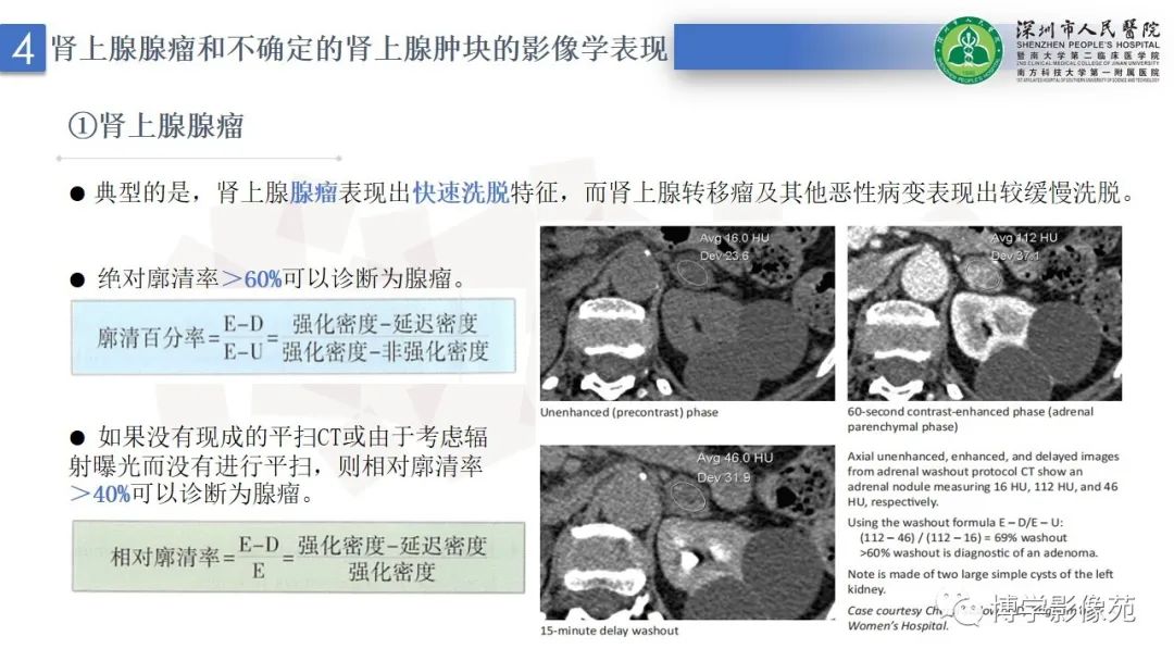 影像PPT - 【PPT】腹膜后间隙及肾上腺常见疾病影像表现-18